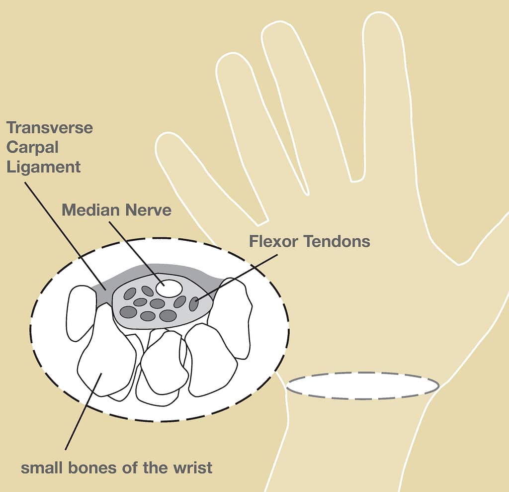 Carpal-Tunnel-Syndrome-Figure-1-1 - Minimally Invasive Carpal Tunnel Surgery
