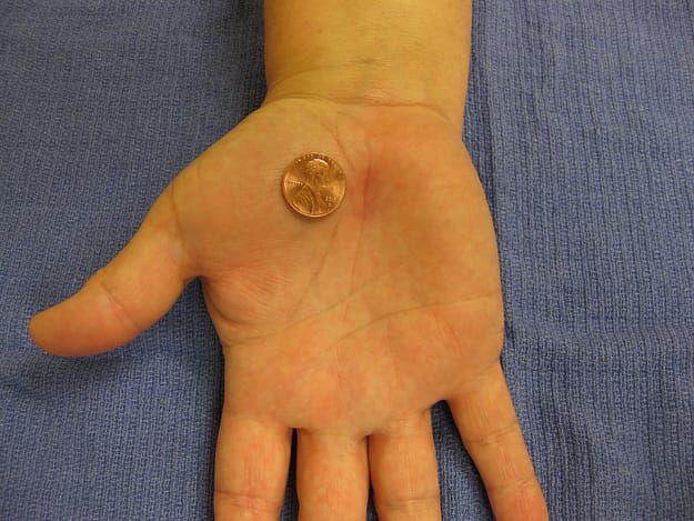 Carpal tunnel treatment with minimally invasive carpal tunnel surgery.